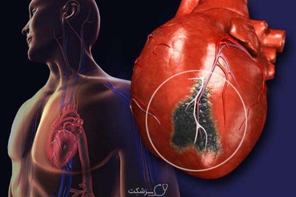 ۸ علامتی که بدن ۱ ماه قبل از سکته قلبی نشان میدهد