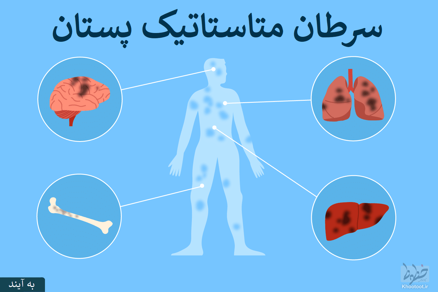 شکست قطعی سرطان نیازمند توسعه غربالگری تشخیص/ تخلیه کامل بافت سرطانی تنها ه راه حل نیست شکست قطعی سرطان نیازمند توسعه غربالگری تشخیص/ تخلیه کامل بافت سرطانی تنها ه راه حل نیست