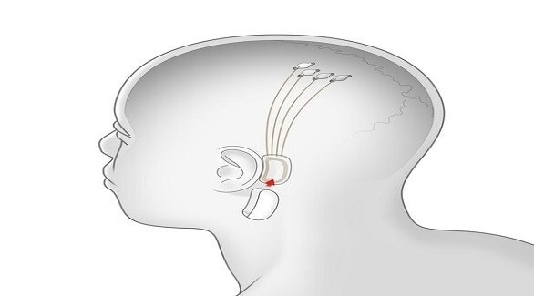 تراشه های مغز ایلان ماسک تا سال 2027 وزوز گوش را درمان می کند