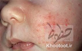 هر آنچه که باید درمورد سرخک بدانیم هر آنچه که باید درمورد سرخک بدانیم