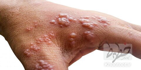 تماس پوست به پوست شایع‌ترین راه انتقال ویروس آبله‌میمون است