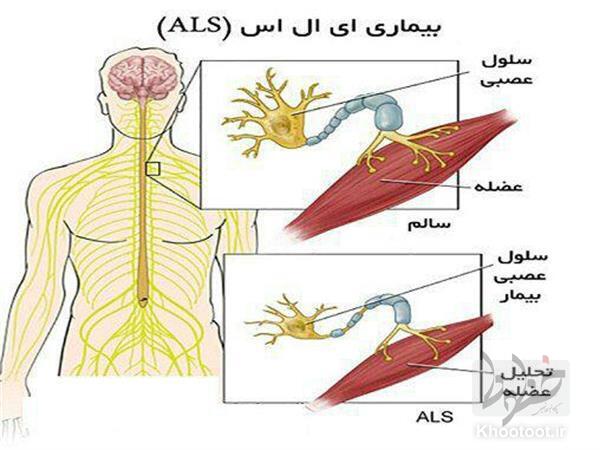 مشاغلی که با خطر بیشتر ابتلا به ALS مواجه هستند