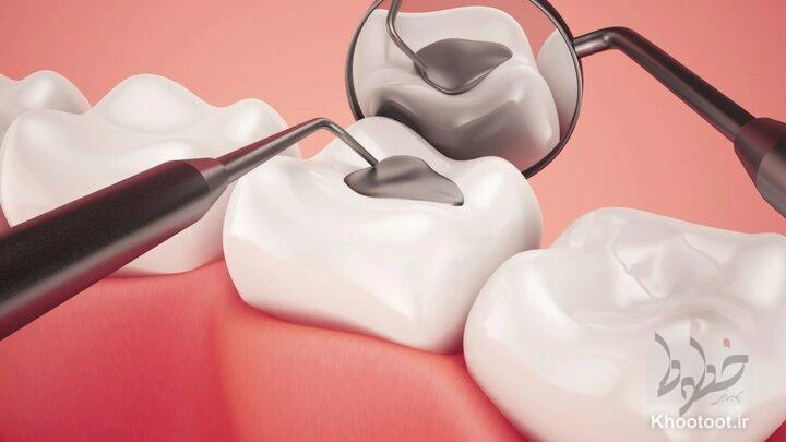 جلوگیری از پوسیدگی دندان با تولید مایعی ارزان!