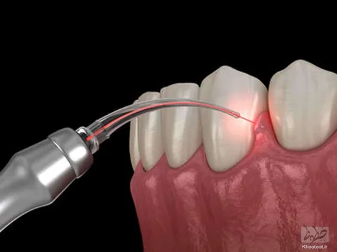 60 ثانیه با خطوط- 2 فروردین| ساخت سلاح لیزری برا ازبین بردن باکتری